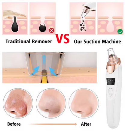 Electric Vacuum Suction Blackhead Remover